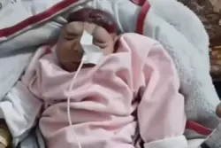 ارتفاع ملحوظ في تشوهات الأجنة بين النساء الحوامل بقطاع غزة